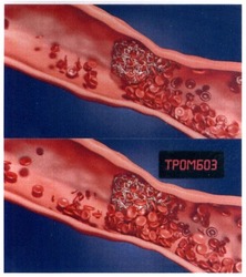 Свідоцтво торговельну марку № 284061 (заявка m201823706): тромбоз